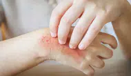 Aşırı Kaşıntı, Kızarıklık, Pullanma, Yanma, Ciltte Çatlama: Dikkat Mantar Olabilirsiniz!