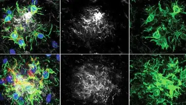 Alzheimer Hastalığında Çığır Açan Tedavi! Bitkin Düşen Beyin Hücreleri Yeniden Programlandı