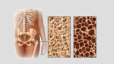 Sessiz katil: Kemik erimesi