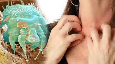 Uyuza karşı evde ne yapmalıyız? Dr. Feridun Kunak'tan uyuza karşı muhteşem karışım