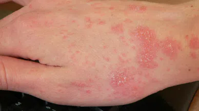 Uyuz salgınına dikkat! 30 kat hızla yayılıyor