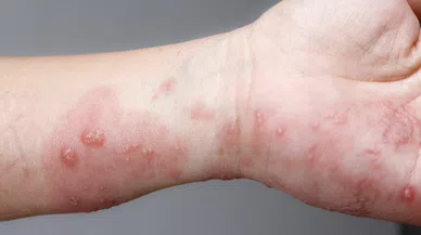 Uyuz salgınında tehlike geçmedi! Vakalar artışta