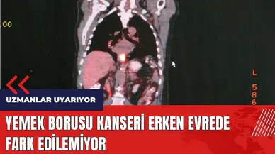 Yemek Borusu Kanseri erken evrede fark edilemiyor