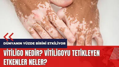 Vitiligo nedir? Vitiligoyu tetikleyen etkenler neler?