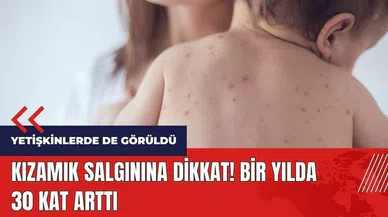 Kızamık salgınına dikkat! Bir yılda 30 kat arttı