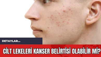 Cilt Lekeleri Kanser Belirtisi Olabilir mi?