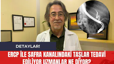 ERCP ile Safra Kanalındaki Taşlar Tedavi Ediliyor Uzmanlar Ne Diyor?