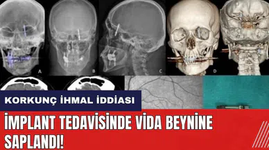 Korkunç ihmal iddiası! İmplant tedavisinde vida beynine saplandı
