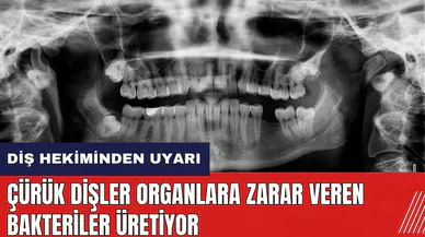 Diş hekiminden uyarı: Çürük dişler organlara zarar veren bakteriler üretiyor