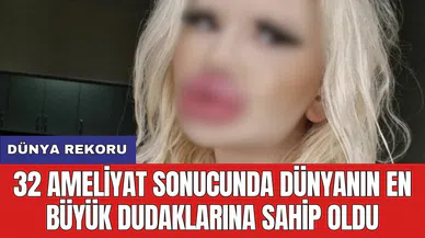 Dünya rekoru: 32 ameliyat sonucunda dünyanın en büyük dudaklarına sahip oldu