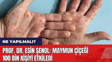 Prof. Dr. Esin Şenol: Maymun Çiçeği 100 bin kişiyi etkiledi