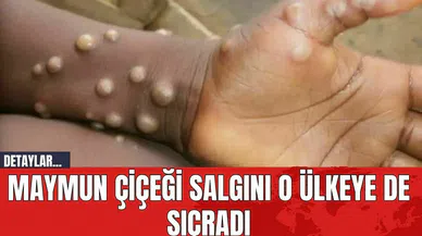 Maymun Çiçeği Salgını Sürüyor! O Ülkeye de Sıçradı