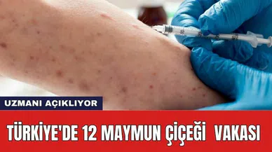 Türkiye'de 12 maymun çiçeği vakası
