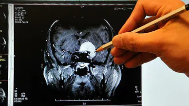 Beyne pıhtı atması nedir? Belirtileri nelerdir?
