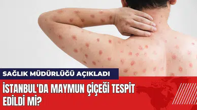 İstanbul'da maymun çiçeği tespit edildi mi? Sağlık Müdürlüğü açıkladı