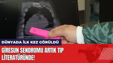 Dünyada ilk kez görüldü: Giresun Sendromu tıp literatüründe!