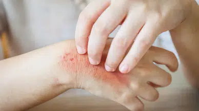 Aşırı Kaşıntı, Kızarıklık, Pullanma, Yanma, Ciltte Çatlama: Dikkat Mantar Olabilirsiniz!