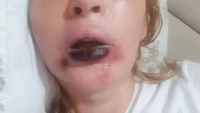 Antalya'da Estetik Faciasında 7 Yıllık Hukuk Çıkmazı