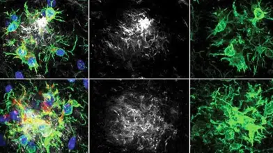 Alzheimer Hastalığında Çığır Açan Tedavi! Bitkin Düşen Beyin Hücreleri Yeniden Programlandı