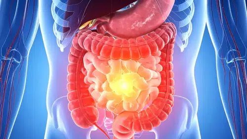 22 Bin Kişi Bu Kansere Yakalanıyor