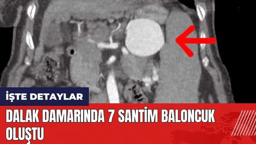 Dalak damarında 7 santim baloncuk oluştu