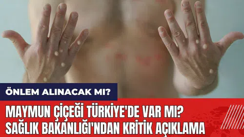 Maymun Çiçeği Türkiye'de var mı? Sağlık Bakanlığı'ndan kritik açıklama