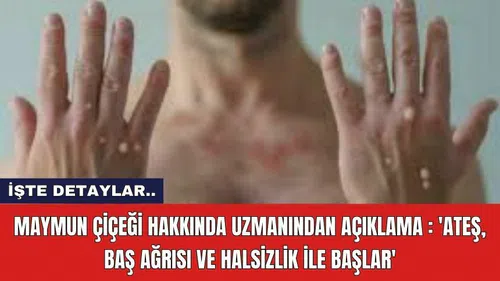 Maymun çiçeği hakkında uzmanından açıklama : 'Ateş, baş ağrısı ve halsizlik ile başlar'