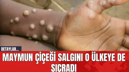 Maymun Çiçeği Salgını Sürüyor! O Ülkeye de Sıçradı