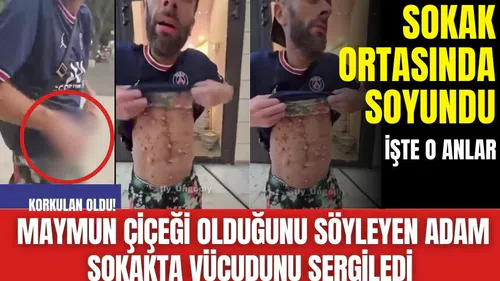 Korkulan oldu! Maymun çiçeği olduğunu söyleyen adam sokakta vücudunu sergiledi