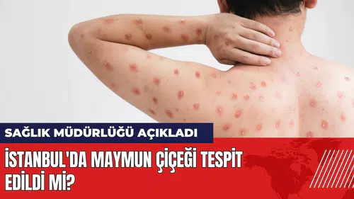 İstanbul'da maymun çiçeği tespit edildi mi? Sağlık Müdürlüğü açıkladı