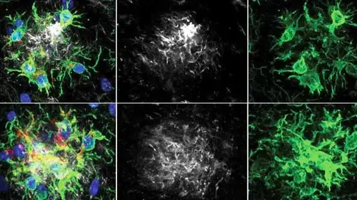 Alzheimer Hastalığında Çığır Açan Tedavi! Bitkin Düşen Beyin Hücreleri Yeniden Programlandı