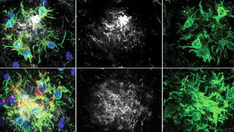 Alzheimer Hastalığında Çığır Açan Tedavi! Bitkin Düşen Beyin Hücreleri Yeniden Programlandı