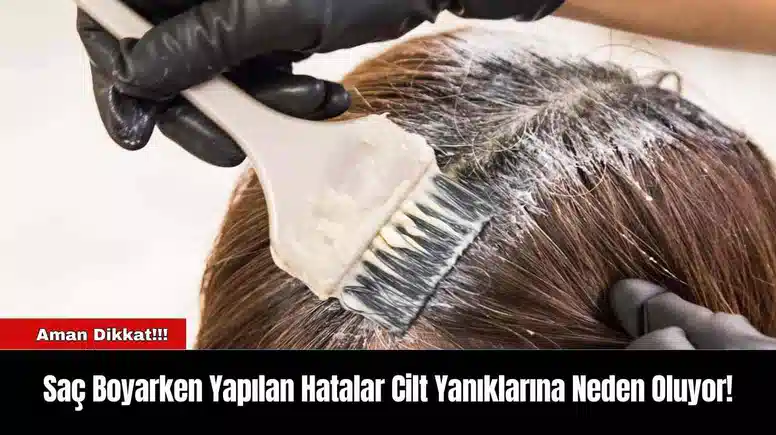 Saç Boyarken Yapılan Hatalar Cilt Yanıklarına Neden Oluyor!