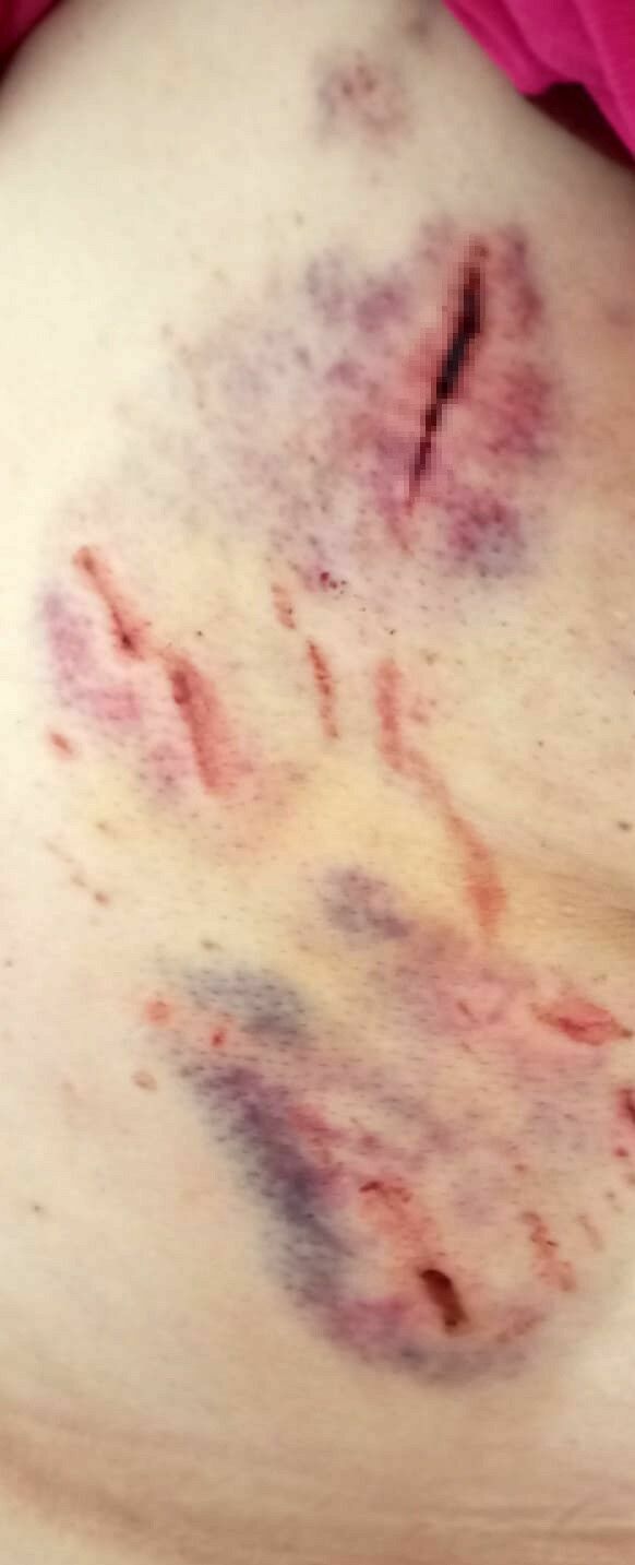 Hatay'da Köpeklerin Saldırısına Uğradı O An Öldüğümü Sandım (2)