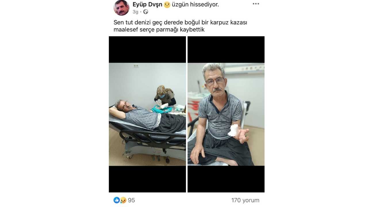 Adanalı Kebapçı Karpuz Keserken Parmağını Kaybetti2