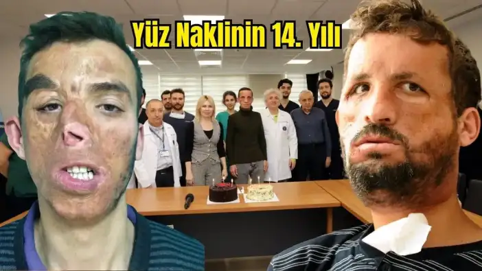 Türkiye'de İlk Yüz Naklinin 14. Yılı! Manavgatlı Uğur Acar: Yüzünü Aldığım Kişinin Yaşındayım