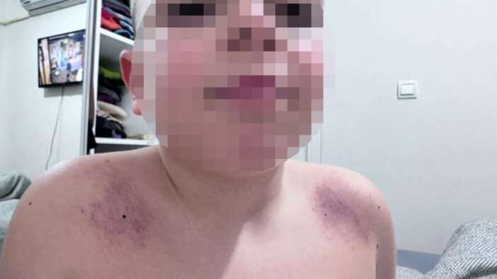 Antalya’da Şiddet Uygulayan Öğretmen İddiası, Veli Darp Şikayeti Etti