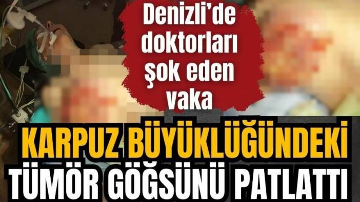 Karpuz büyüklüğündeki tümör göğsünü patlattı