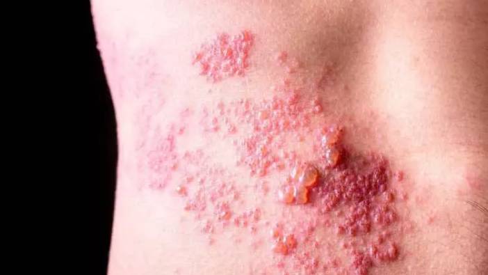 Zonaya ne iyi gelir? Zona tedavisinde kullanılan şifalı bitkiler neler?