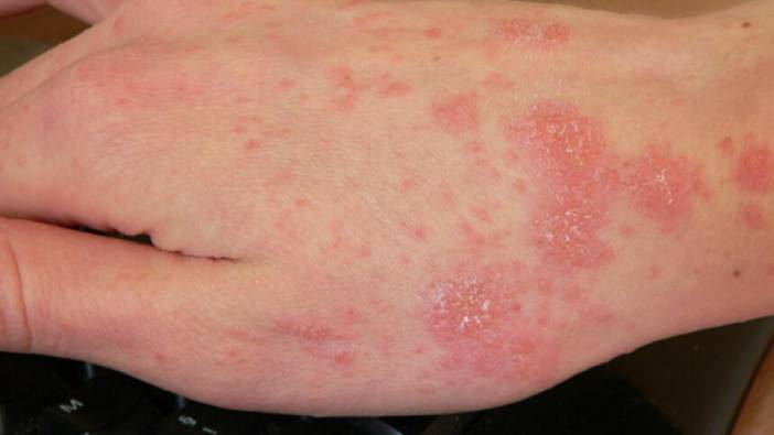 Uyuz salgınına dikkat! 30 kat hızla yayılıyor