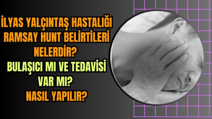 İlyas Yalçıntaş hastalığı Ramsay hunt belirtileri nelerdir? Bulaşıcı mı ve tedavisi var mı? Nasıl yapılır?