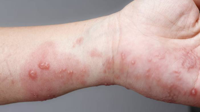 Uyuz salgınında tehlike geçmedi! Vakalar artışta