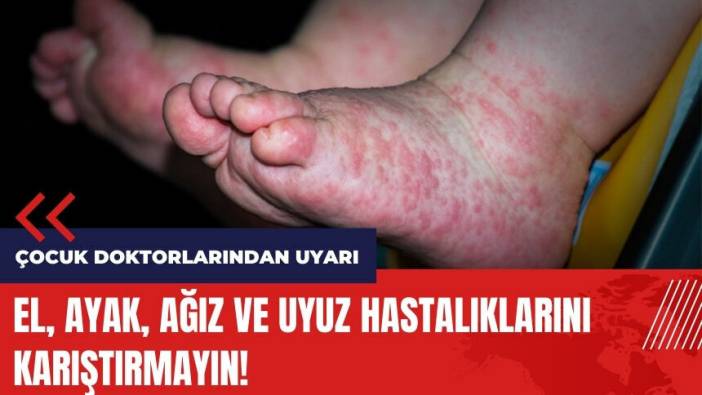 Çocuk doktorlarından uyarı: El ayak ağız ve uyuz hastalıklarını karıştırmayın