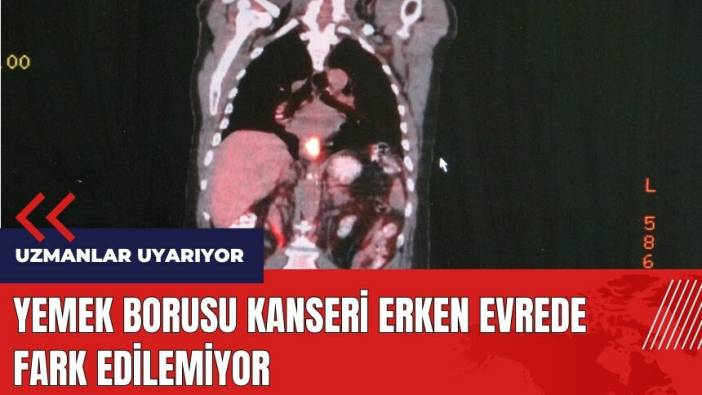 Yemek Borusu Kanseri erken evrede fark edilemiyor