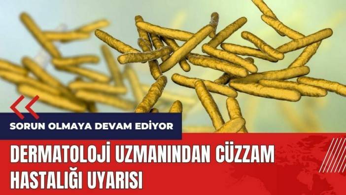 Dermatoloji uzmanından Cüzzam hastalığı uyarısı