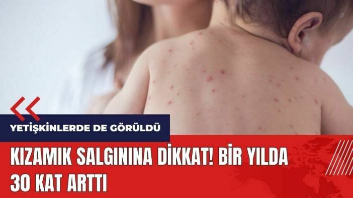 Kızamık salgınına dikkat! Bir yılda 30 kat arttı
