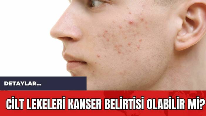 Cilt Lekeleri Kanser Belirtisi Olabilir mi?