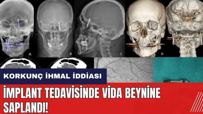 Korkunç ihmal iddiası! İmplant tedavisinde vida beynine saplandı