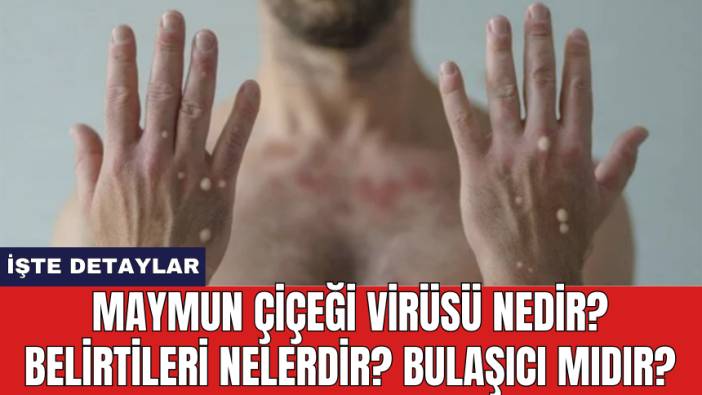 Maymun Çiçeği Virüsü Nedir? Belirtileri Nelerdir? Bulaşıcı Mıdır?