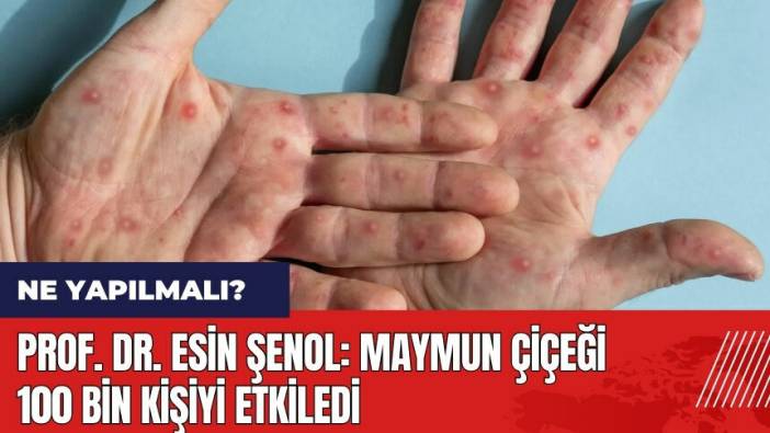 Prof. Dr. Esin Şenol: Maymun Çiçeği 100 bin kişiyi etkiledi